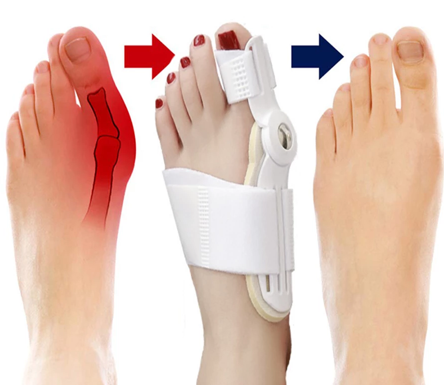 Best Orthopedic Bunion Corrector - Non-Surgical Natural Treatment & Relief - Westfield Retailers
