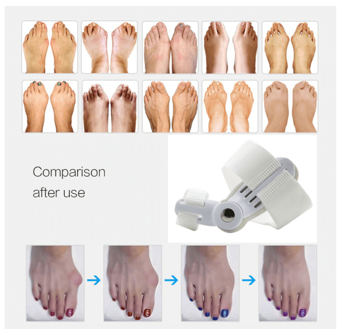 Best Orthopedic Bunion Corrector - Non-Surgical Natural Treatment & Relief - Westfield Retailers