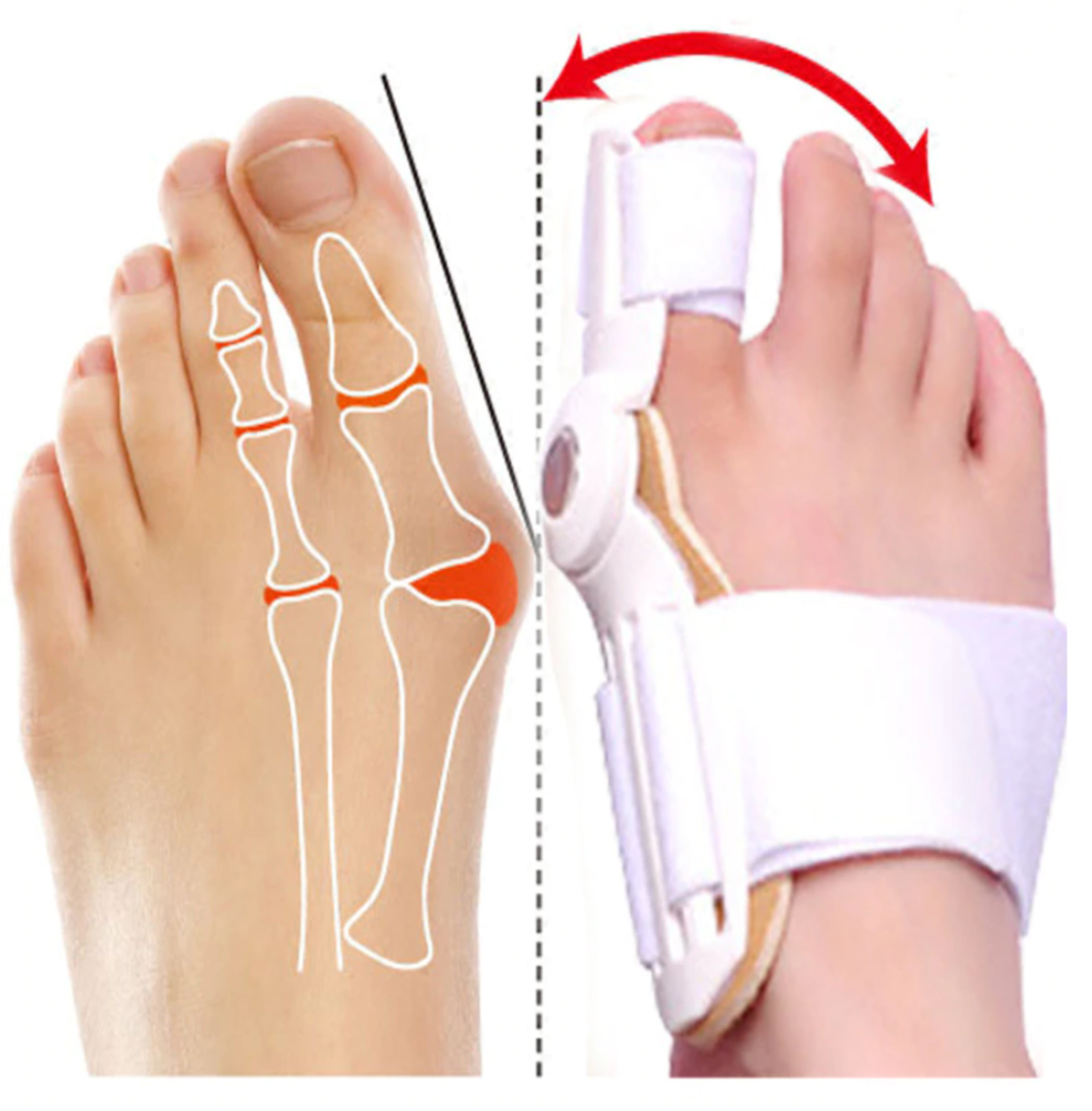 Best Orthopedic Bunion Corrector - Non-Surgical Natural Treatment & Relief - Westfield Retailers