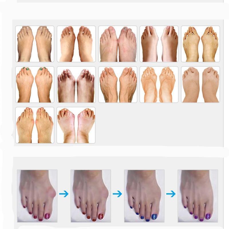 Best Orthopedic Bunion Corrector - Non-Surgical Natural Treatment & Relief - Westfield Retailers