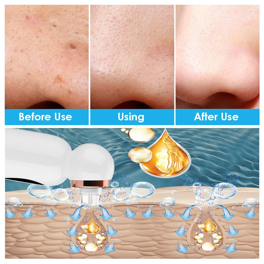 HexoSkin™ Hydrodermabrasion Blackhead Remover