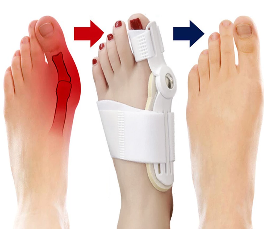 Best Orthopedic Bunion Corrector -  Non-Surgical Natural Treatment & Relief - Westfield Retailers