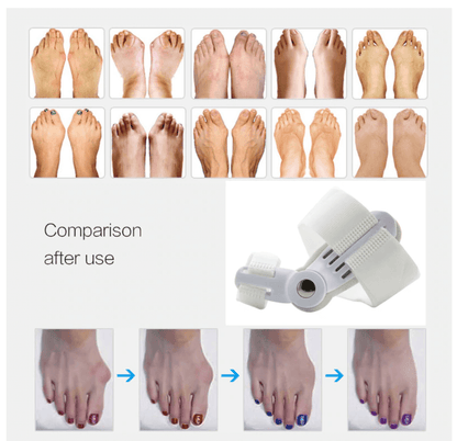 Best Orthopedic Bunion Corrector -  Non-Surgical Natural Treatment & Relief - Westfield Retailers